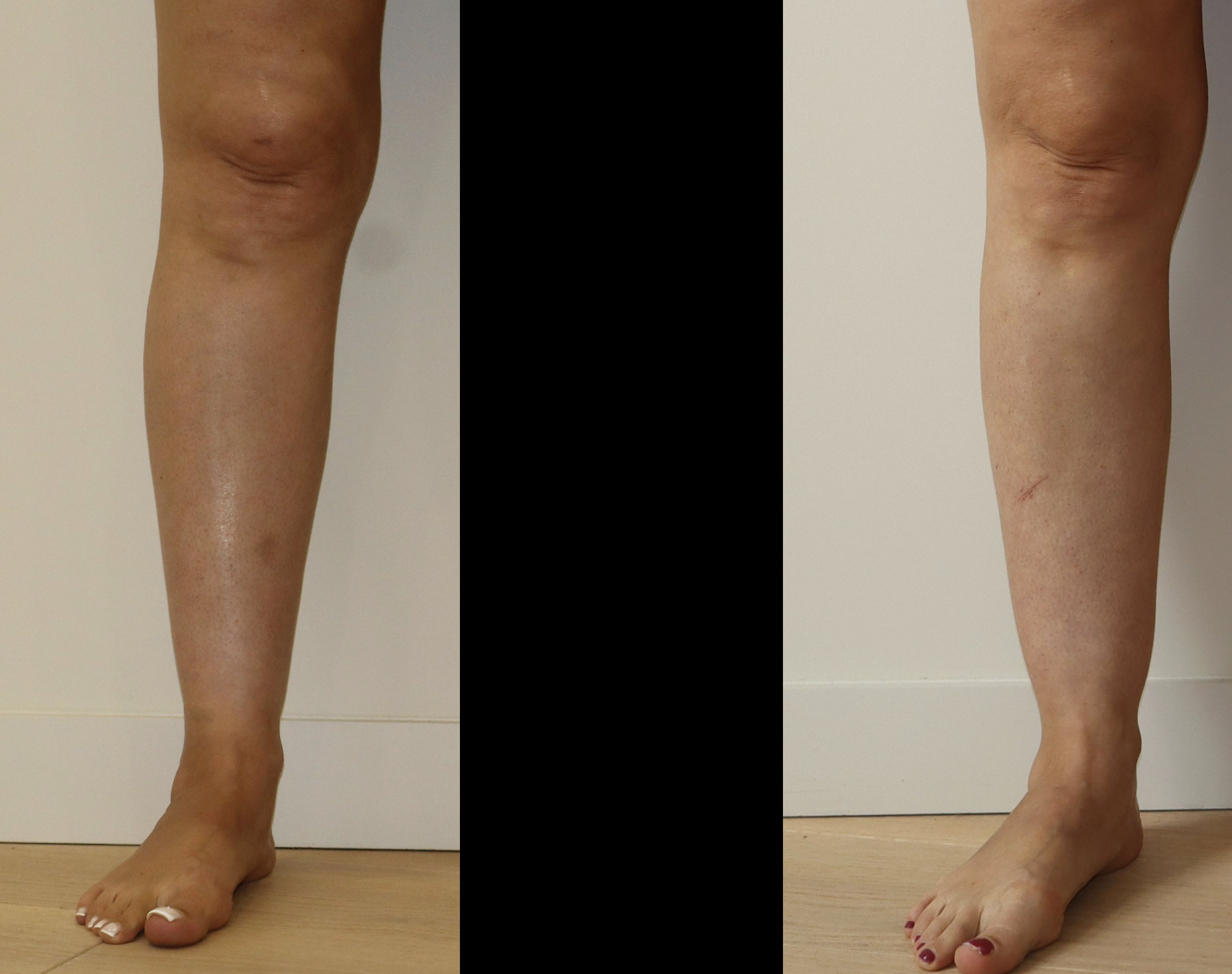 Avant/Après lipoaspiration lipoedeme